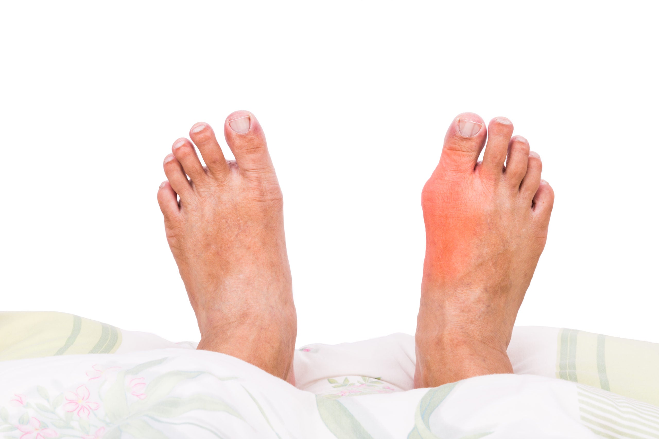 Fighting Excess Uric Acid? Avoid this Ingredient